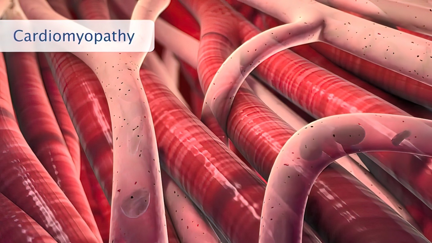 Cardiomyopathy